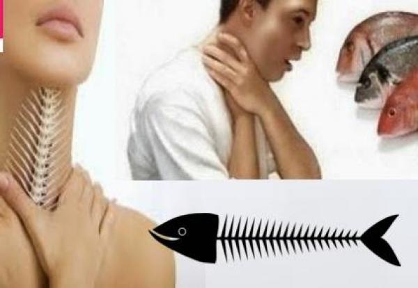 طريقة سهلة لإزالة شوك أو عظام السمك من الحلق