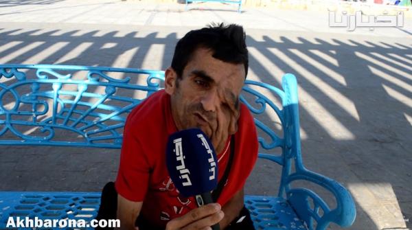 شاب مغربي بنصف وجه : كيبقى فيا الحال بسبب كلام الناس وملي كنت صغير ما كانتش هكدا