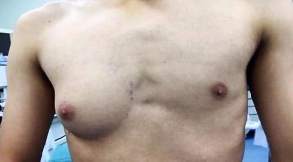 شاب ينمو أحد ثدييه بشكل كبير بسبب الوجبات السريعة