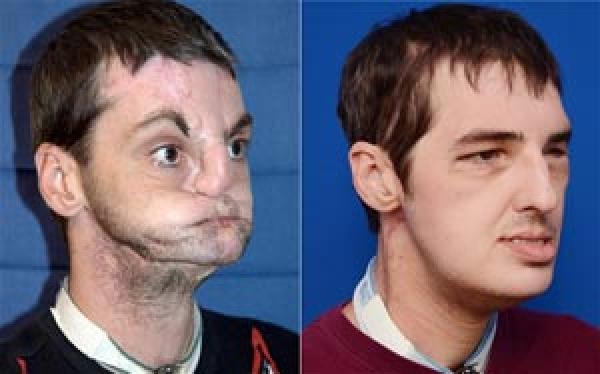 أضخم عملية زرع وجه تعيد لشاب وجهه وحياته