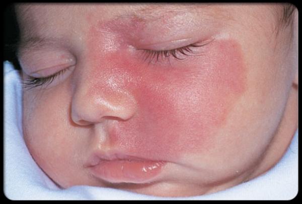 اكتشاف الطفرة الجينية المسؤولة عن الوحمة الجلدية