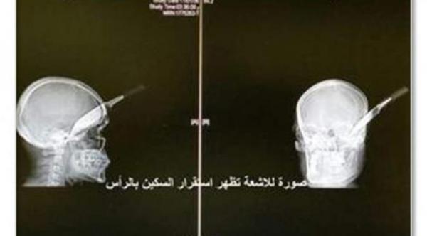 اخترقت سكين رأسه 8 سنتيمترات ولم يصب بأذى