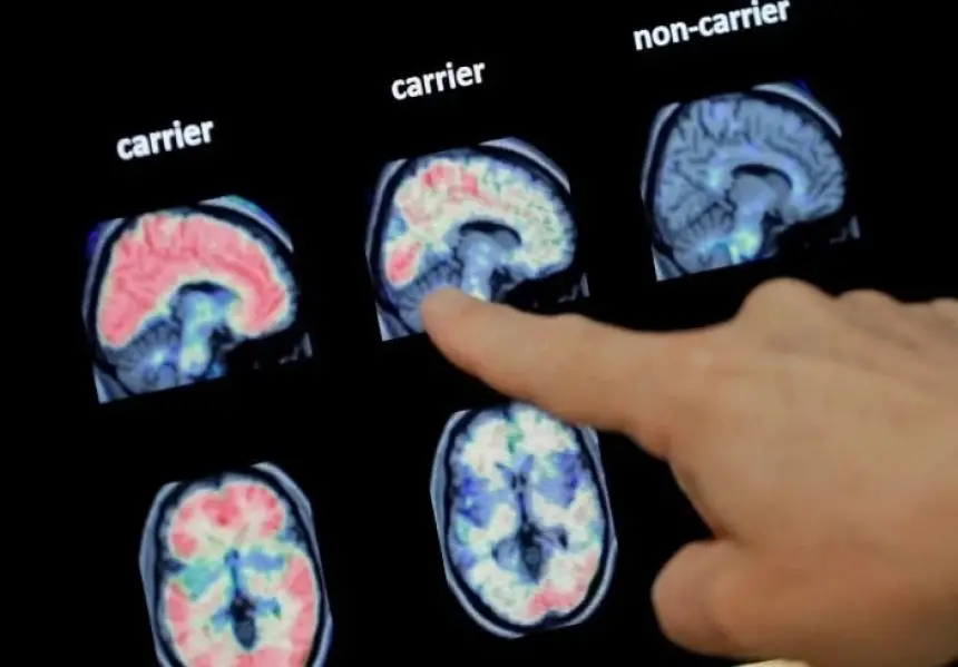 اختراق علمي.. دراسة أنسجة دماغ بشرية حية تكشف أسرار الزهايمر مبكراً