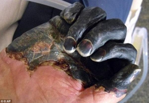 وباء قتل ثلث سكان أوروبا يظهر من جديد في إفريقيا