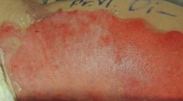 تطوير مادة كيميائية  تساعد على شفاء الجروح