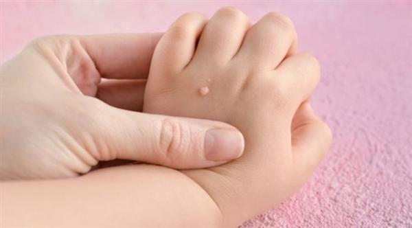 الثآليل لدى الأطفال...أسبابها وطرق الوقاية منها