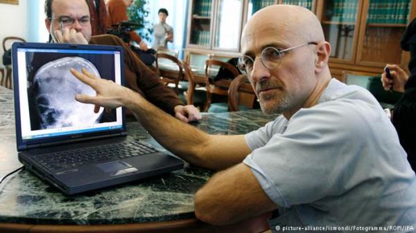 طبيب: زراعة أول رأس حي في العالم أصبحت وشيكة