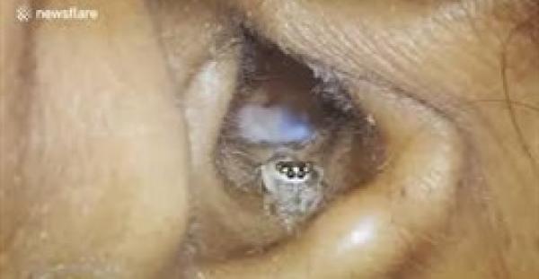 إخراج عنكبوت حي من أذن امرأة (فيديو)