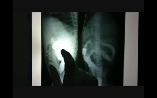 حكاية امرأة عاشت بأدوات طبية في رحمها 15 سنة