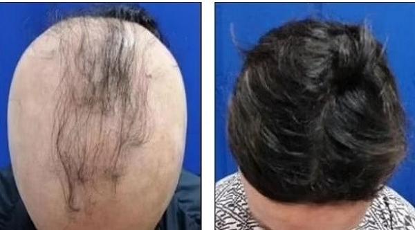 عقار ثوري فعال لحل مشكلة الصلع الناجمة عن الثعلبة البقعية