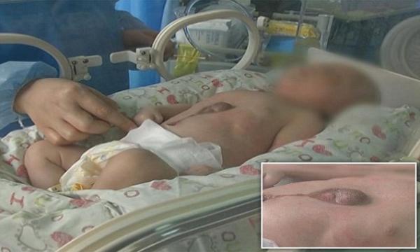 بالفيديو: لحظة مؤثرة لطفل ولد بقلب خارج بطنه