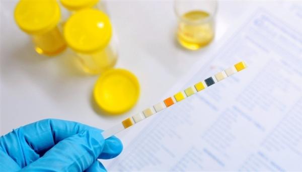 تغير لون ورائحة البول مؤشر على الاصابة بهذه الأمراض