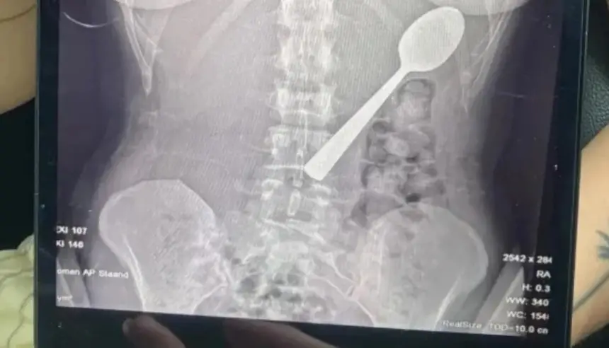 كلب يقفز فجأة فيتسبب بابتلاع امرأة بلجيكية ملعقة بطول 17 سنتيمتراً