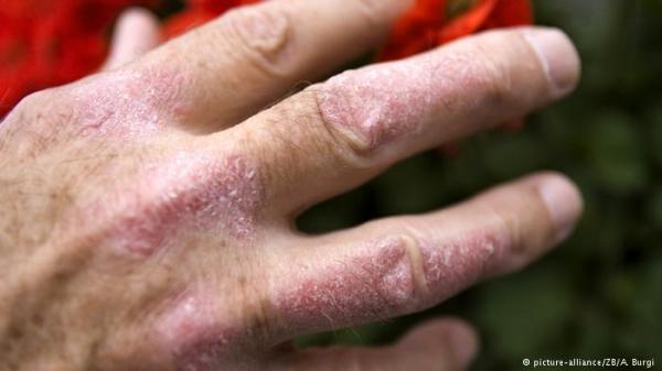حالات مرض الجرب تزداد إنتشارا في ألمانيا