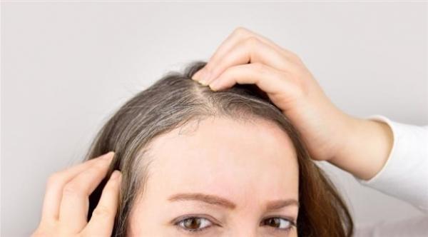 تراجع كثافة الشعر ينذر بمشكلة صحية