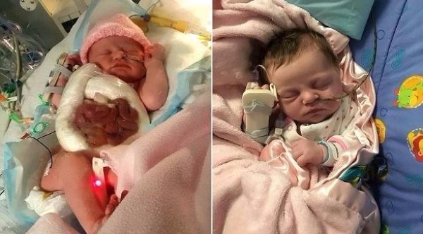 طفلة تولد وأمعاؤها خارج جسدها