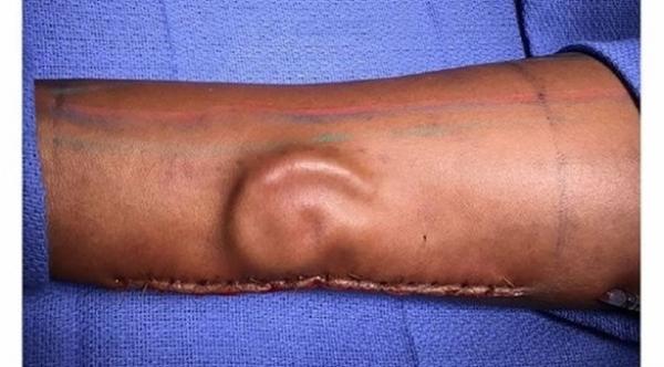 زراعة أذن في ذراع جندية لتعويض أذنها المفقودة