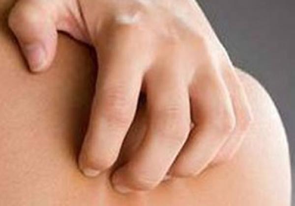 اكتشاف مادة كيميائية تسبب الرغبة فى «حكة» الجلد