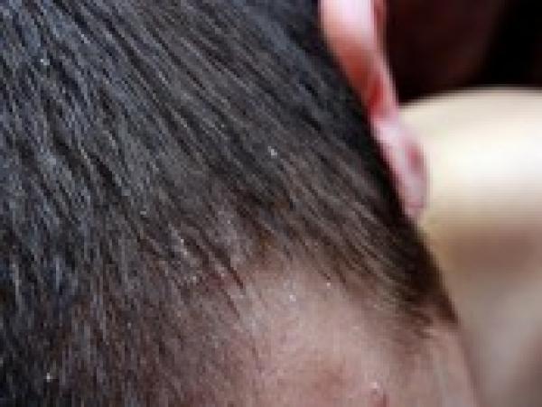 كيف تمنع ظهور قشرة الرأس مجدداً