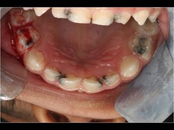 وصفة رائعة لتحمي نفسك من التسوس نهائياً  !