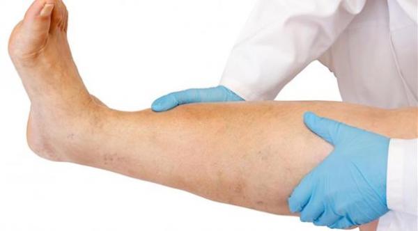 علامات وأعراض تجلّط الدم في الساقين