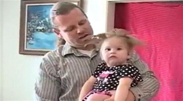 مرض غريب يوقف شعر طفلة أمريكية تعرضت والدتها لصاعقة أثناء الحمل