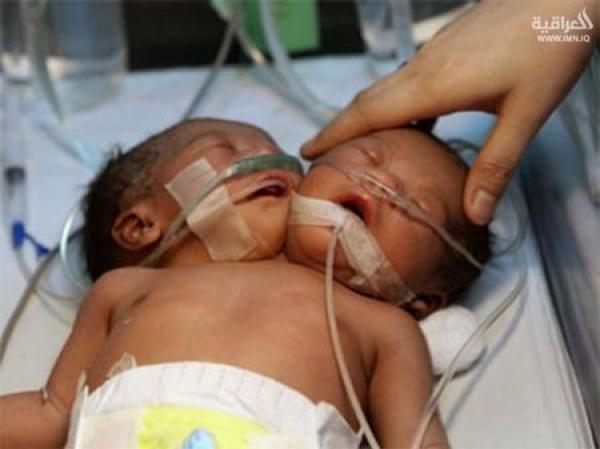 ولادة طفل برأسين في البرازيل.. الدماغان منفصلان ويتشاركان الجسم