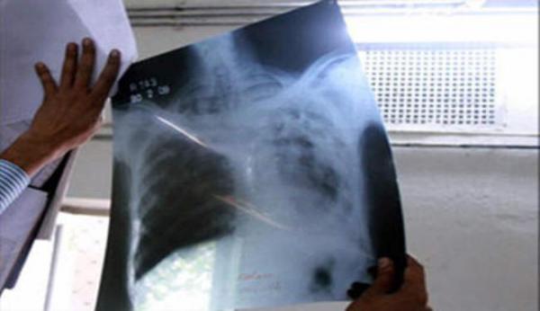 استنفار صحي بعد ظهور السل بمؤسسات تعليمية بالبيضاء