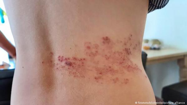 النمشات الدموية أين تظهر وما خطورتها؟