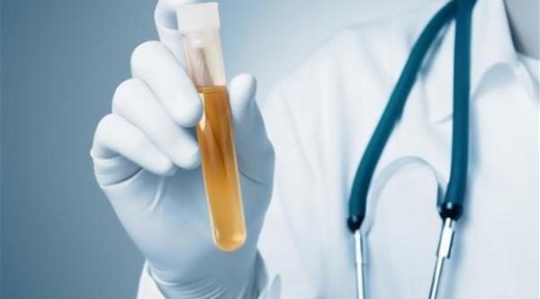 ما سبب تغير لون البول؟