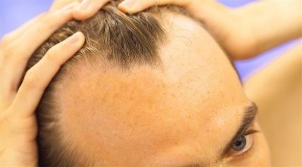 كيف يمكن خفض التوتر وتقليل الصلع؟