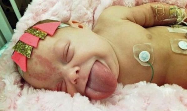 طفلة تولد بلسان شخص بالغ ( صور )