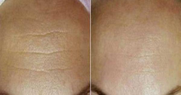 الحل النهائي للقضاء على التجاعيد خلال 7 أيام!