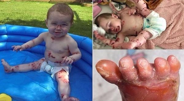 هذه الطفلة لا يمكن لوالدتها احتضانها بسبب مرض نادر