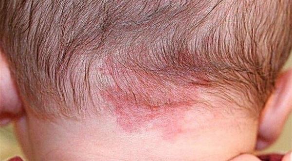 لماذا تظهر وحمة حمراء في رقبة بعض الرضع؟