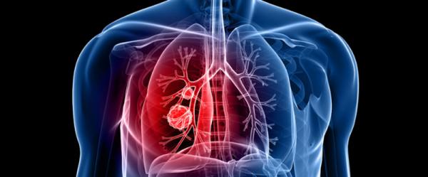 اكتشاف فيروس يسبب وباء التهاب الرئتين