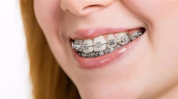 تقويم الأسنان متى يكون ضرورياً؟
