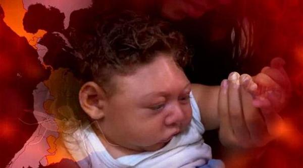 3 دراسات لبرهنة علاقة سببية بين زيكا وتشوهات المواليد