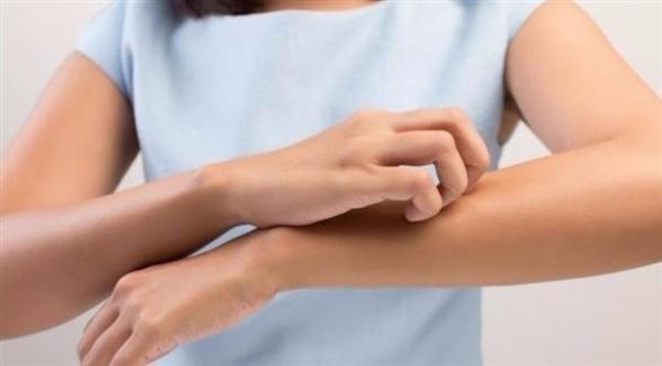 هكذا تحدد سبب نوبات التهاب الجلد العصبي