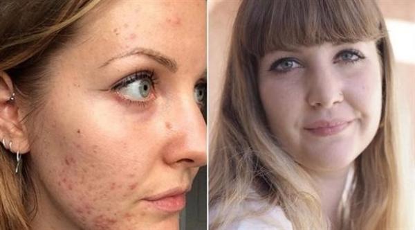 كيف تخلصت هذه الفتاة من حب الشباب نهائياً؟