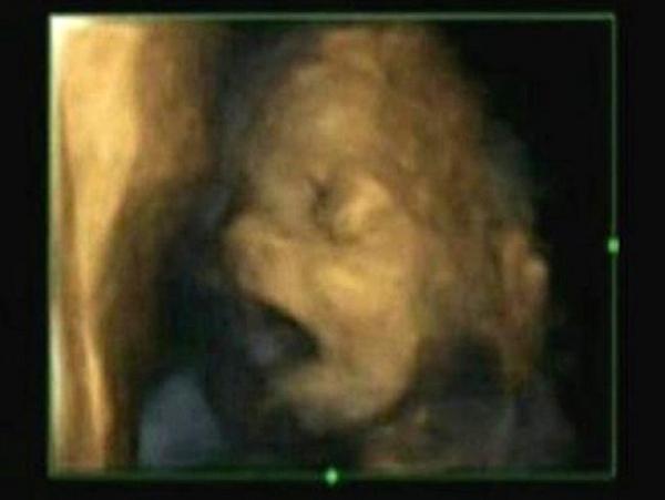 الجنين يتثاءب في بطن الأم.. مراراً وتكراراً