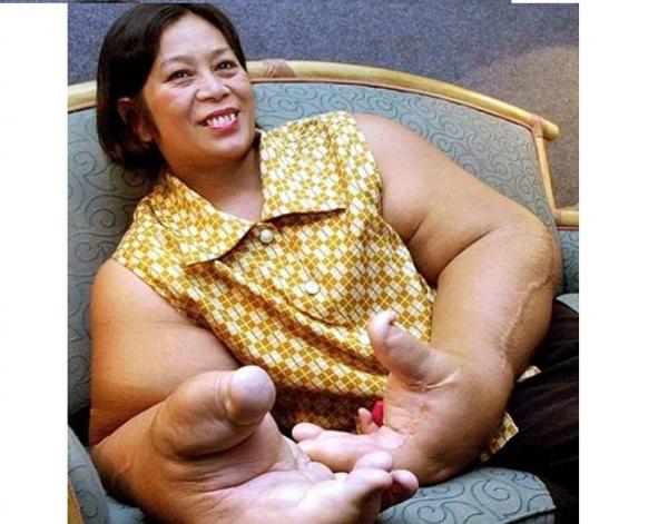 بالفيديو .. معاناة سيدة تحمل «أضخم ذراعين في العالم»