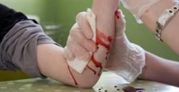 7 علاجات منزلية لتطهير الجروح ووقف النزيف بسرعة