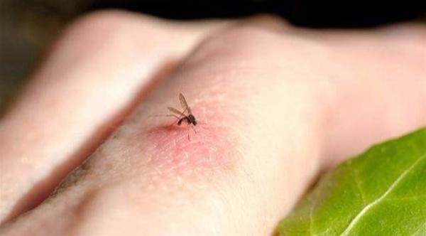 8 علاجات منزلية للحكة الناتجة عن لدغات البعوض