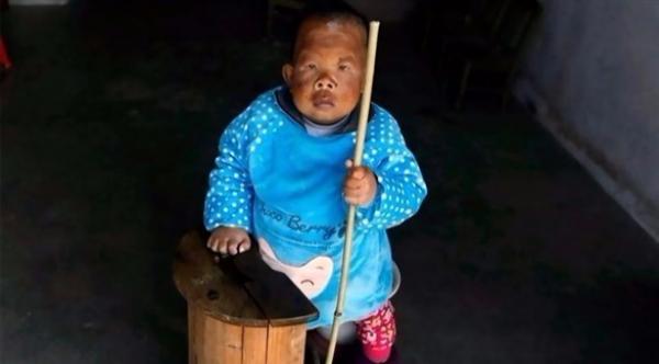 ثلاثيني يعيش بجسد طفل بعمر عامين بسبب حالة نادرة