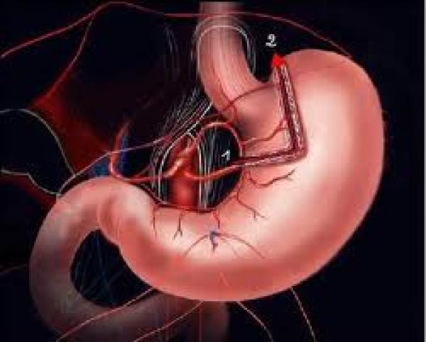 8 مميزات تجعل عملية تكميم المعدة أهم جراحات التخلص من السمنة