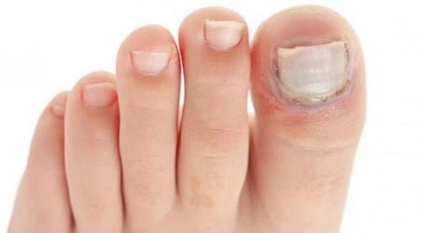 تغير لون أظافر القدم ينذر بالفطريات