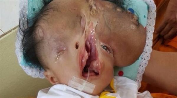 طفل يولد بلا جمجمة وبنصف وجه في تايلند