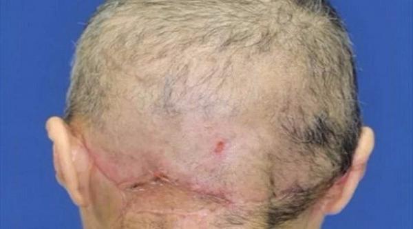 فقدت فروة رأسها بالكامل بآلة غزل القطن