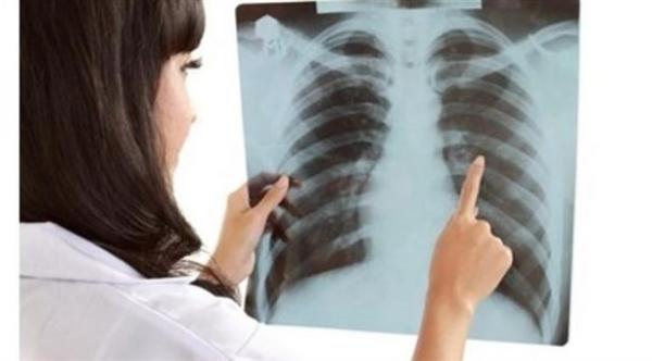 أمريكا: ازدياد معدلات سرطان الرئة لدى النساء